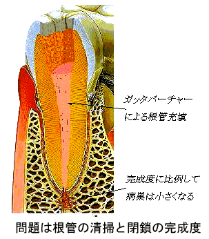 嚢胞が悪化 河田歯科医院