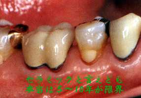 あなたは一生「自分の歯」で食べられますか？ かしこい歯医者の