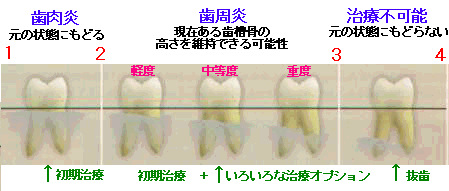 歯周ポケット